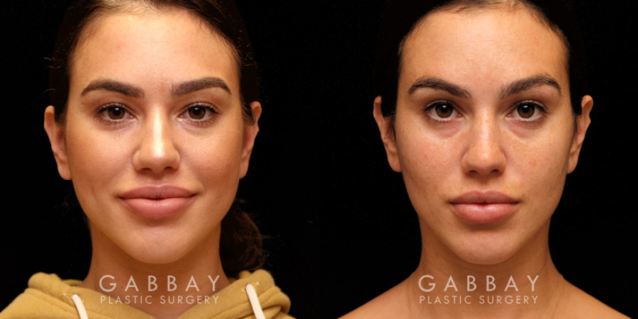 Contouring Beyond Makeup: What Buccal Fat Removal Can Achieve
